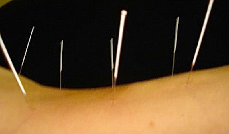 Acupuncture - A Great Deal extra Than Meets the Eyes