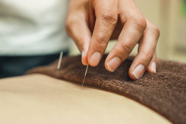 Acupuncture as a Good Alternative Medical Care for Fibromyalgia