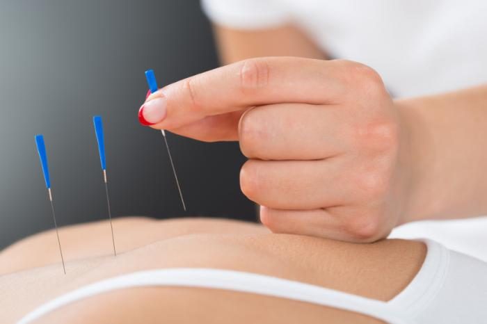 acupuncture-as-a-good-alternative-medical-care-for-fibromyalgia