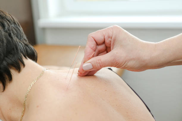 Acupuncture for Irritable Bowel Syndrome