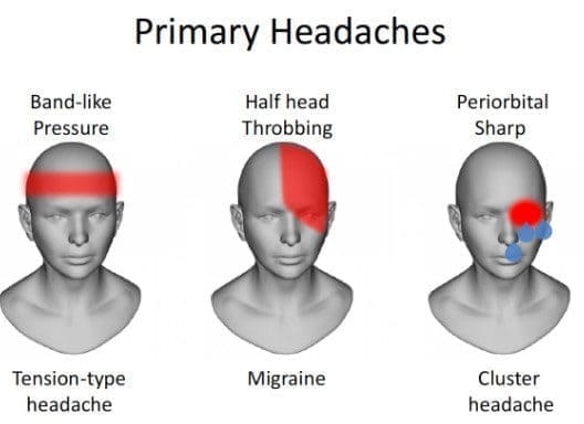 different type of headaches, Acupuncture For Headache