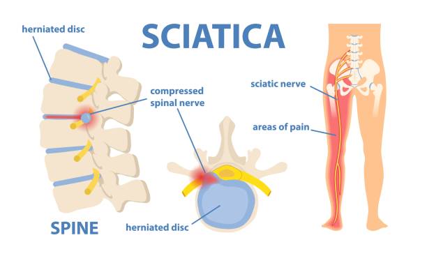 Jacksonville Chiropractic treats Sciatica Pain in Jacksonville Florida