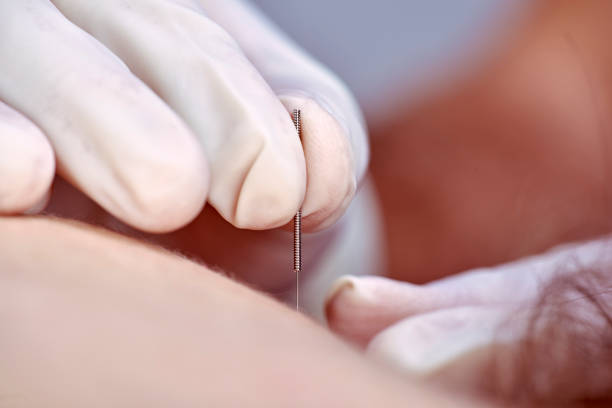 Dry Needling