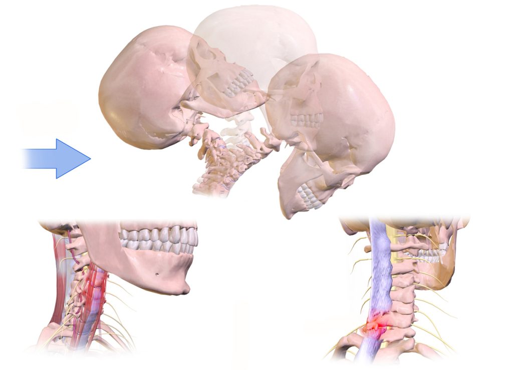 Non-Surgical Treatments for Whiplash Injuries 8 Whiplash injuries, Whiplash,