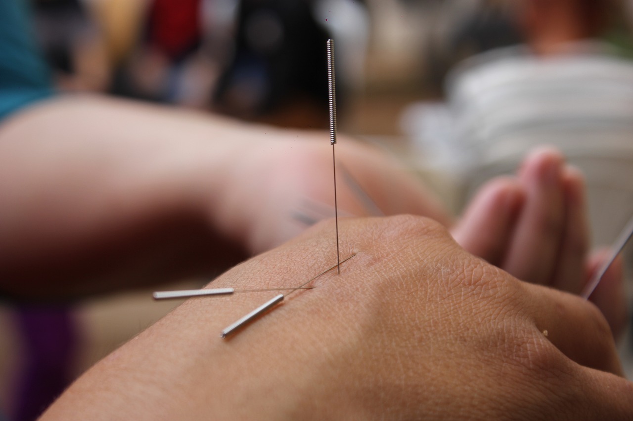 Top 10 Benefits of Acupuncture,